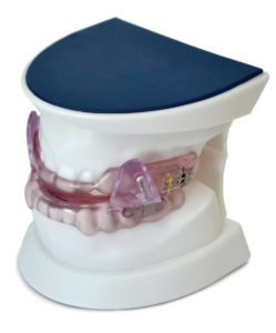 customized oral appliance on a set of model teeth
